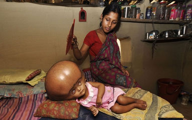 印度三岁小女孩患脑积水头是正常小孩头三倍